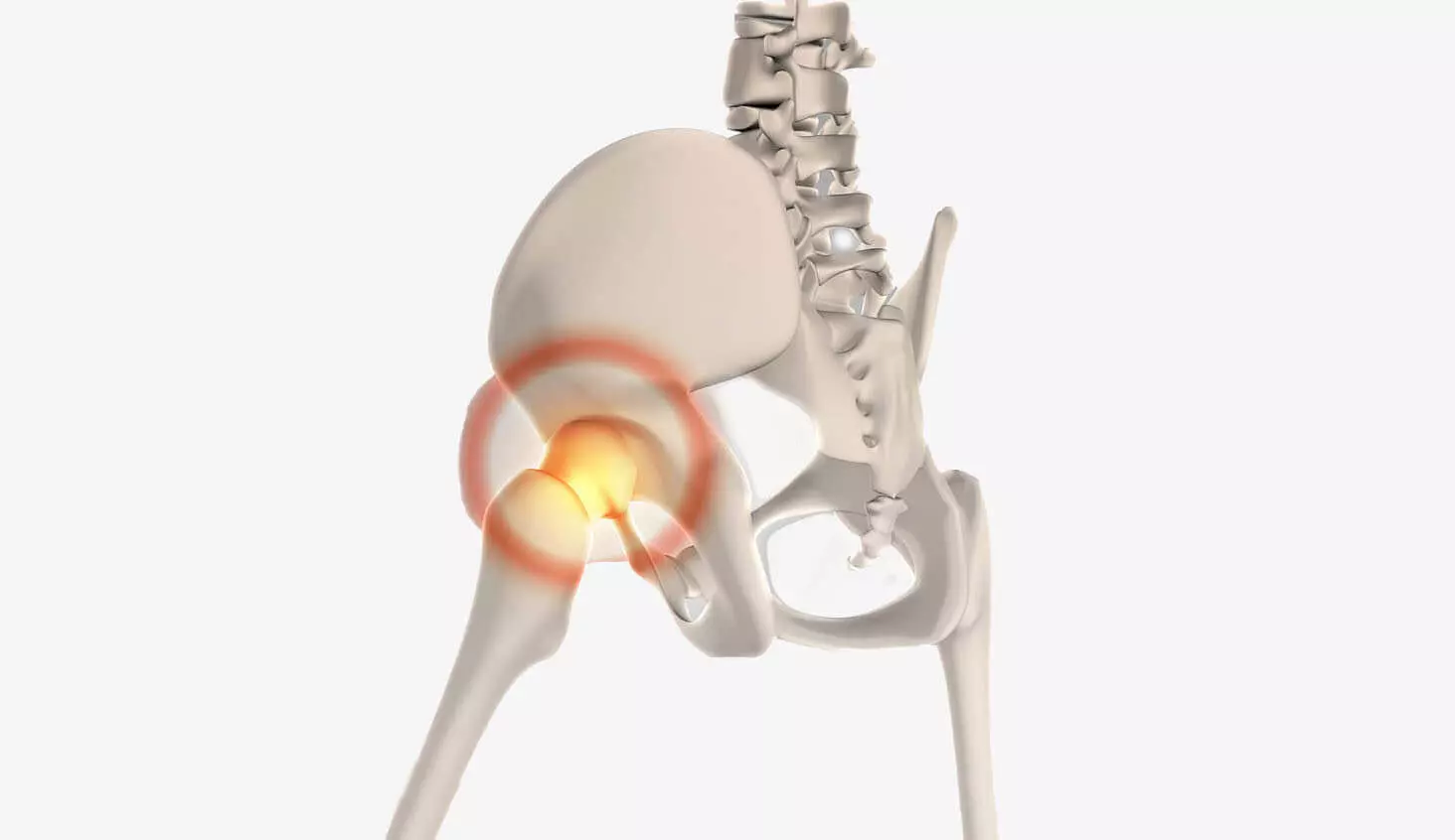Hip Joint Prosthesis