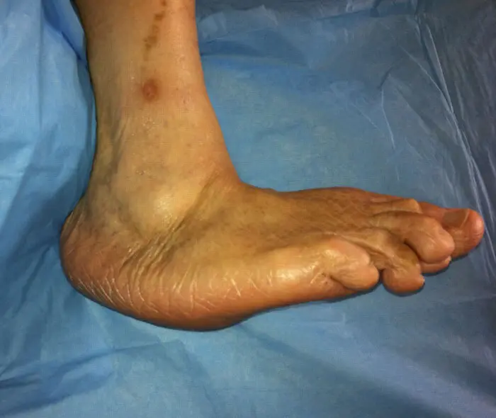 Charcot Foot (Diabetic Foot)