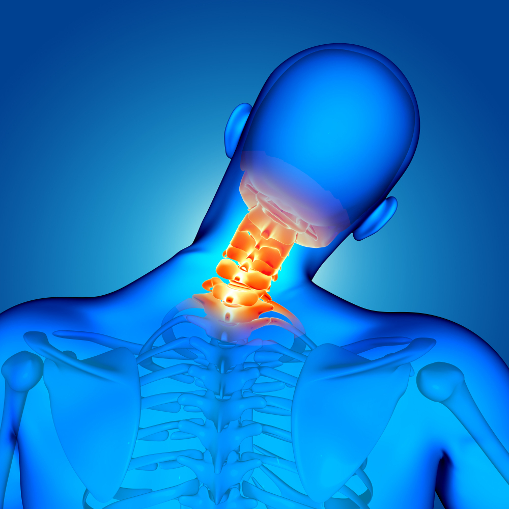 What is Cervical Disc Herniation?